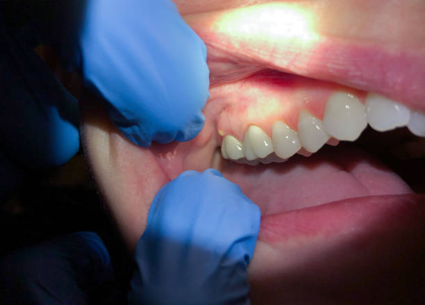 Best Emergency Tooth Extraction in Des Allemands, LA